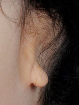 Microtia: Photo of an ear without an ear canal.