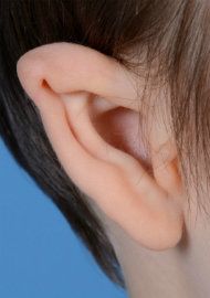 Photo of an ear affected by a mild case of microtia.