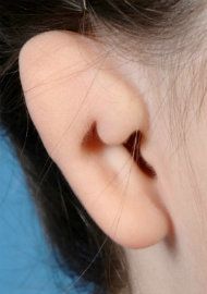 Photo of an ear affected by a moderate case of microtia.