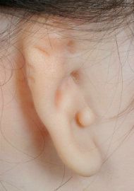 Photo of an ear heavily affected by microtia.