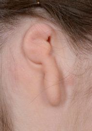 Photo of an ear affected by a slightly advanced case of microtia.