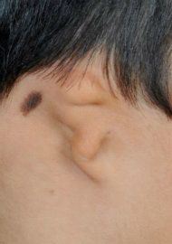 Photo of an ear affected by a moderate to severe case of microtia.
