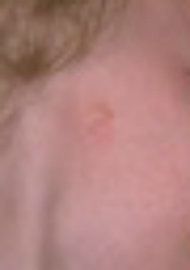Photo of an ear affected by a severe case of microtia.