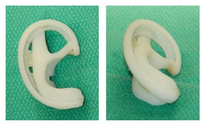 Unattached MEDPOR ears