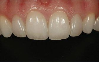 After dental bonding photo