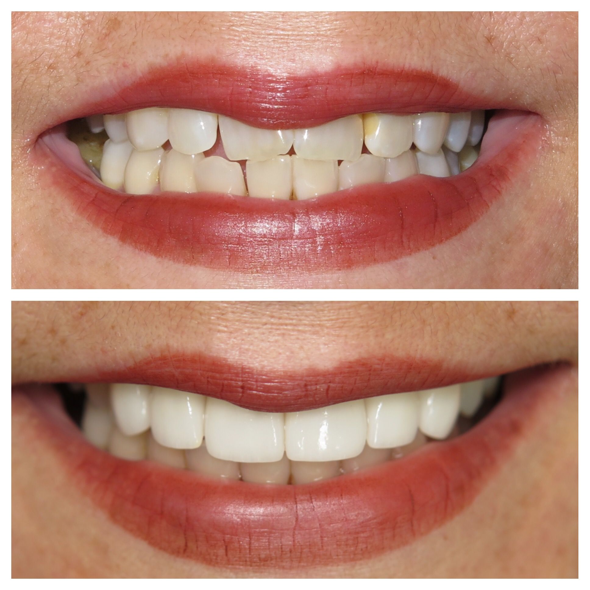 Before and after of stained, crooked teeth