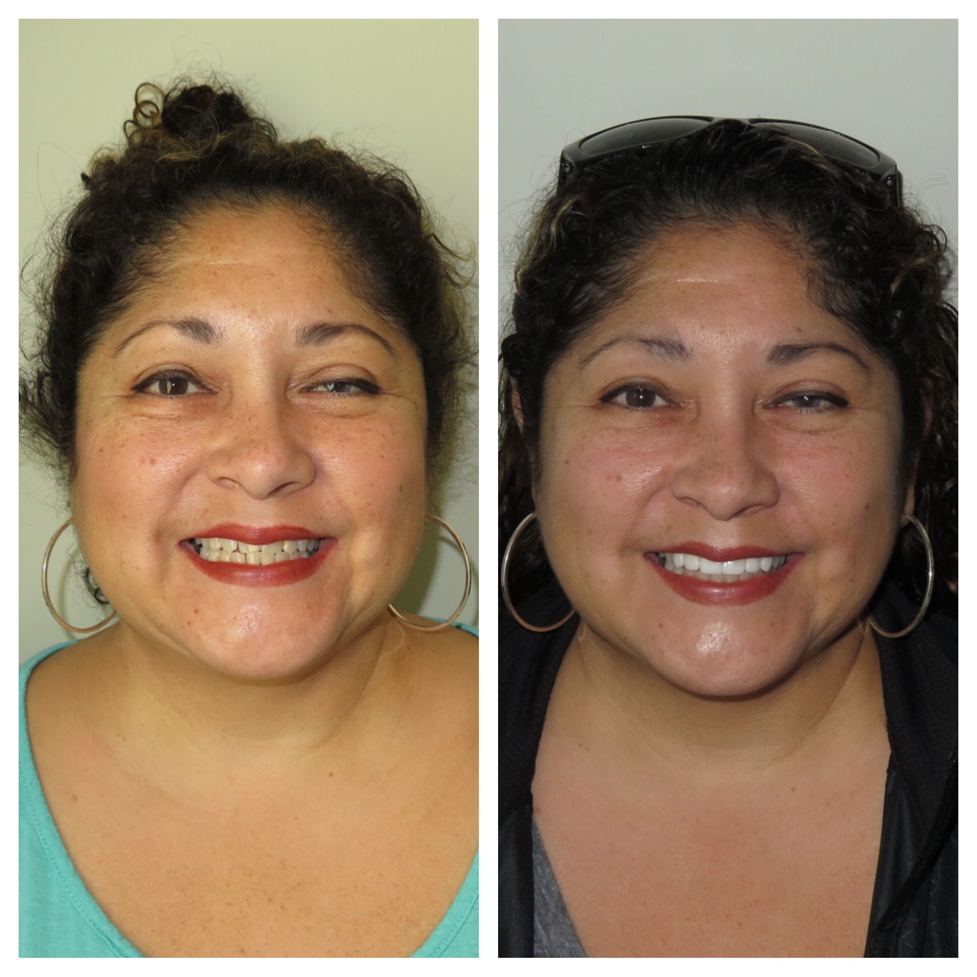 Before and after of patient with stained teeth