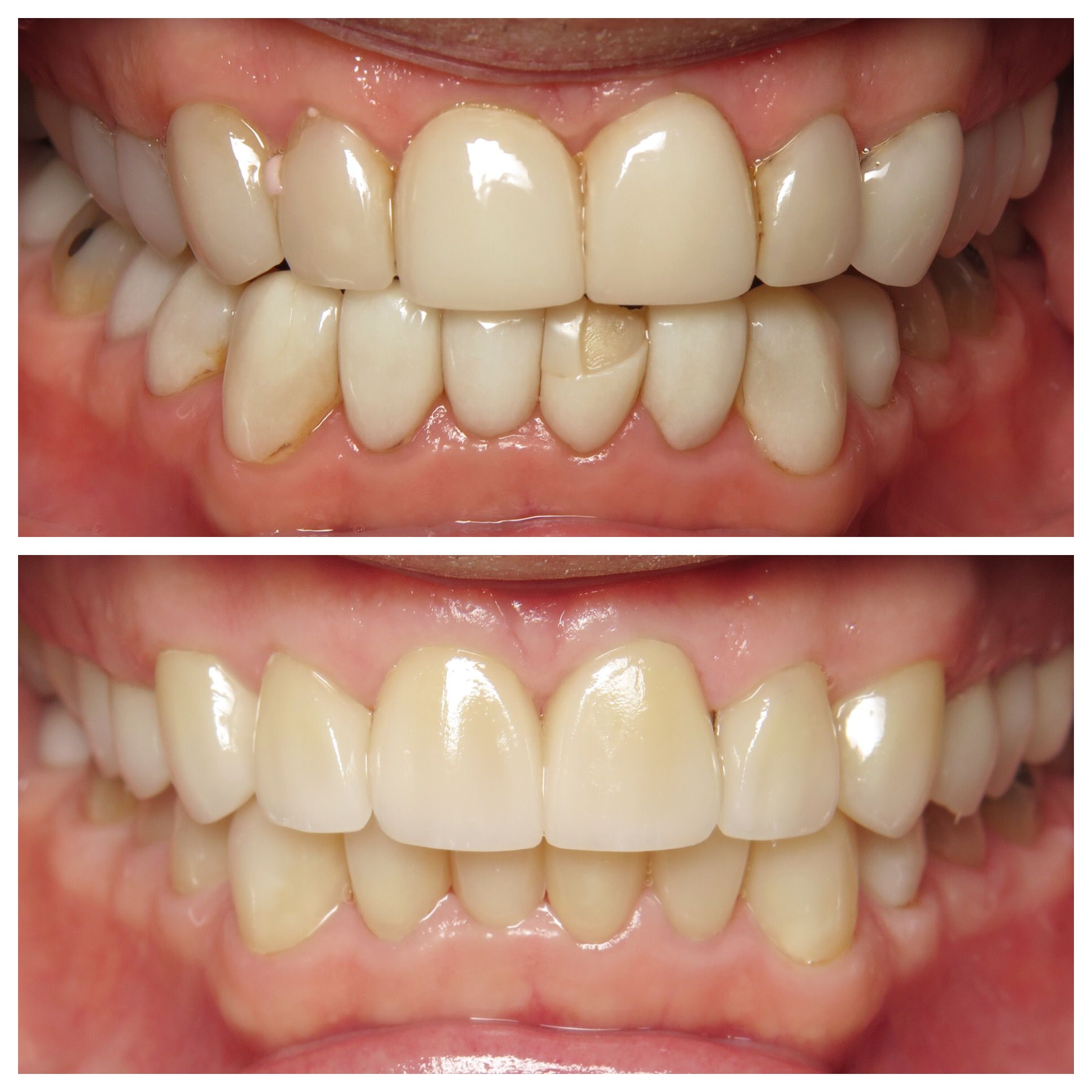 Before and after of cracked teeth