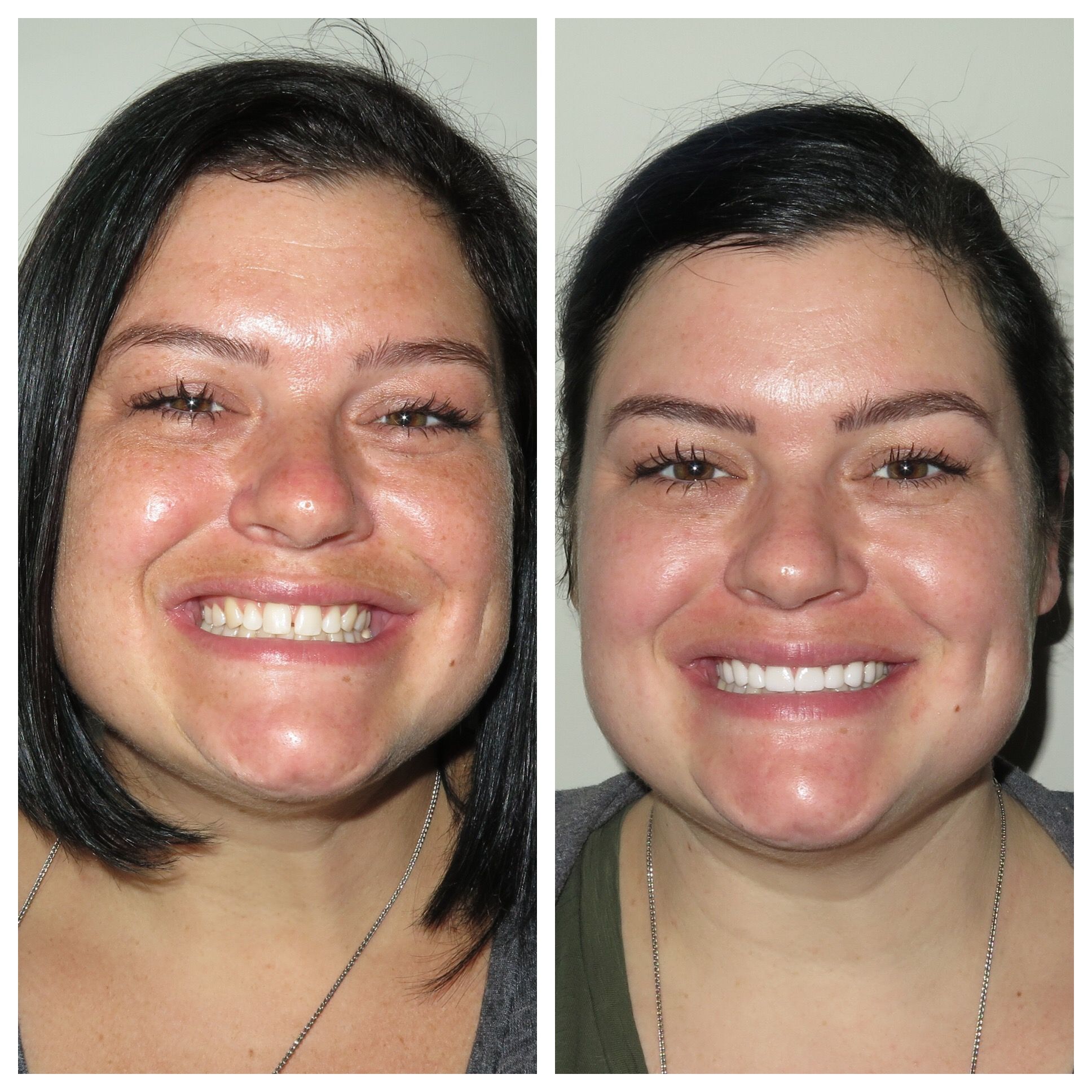 Before and after of younger woman