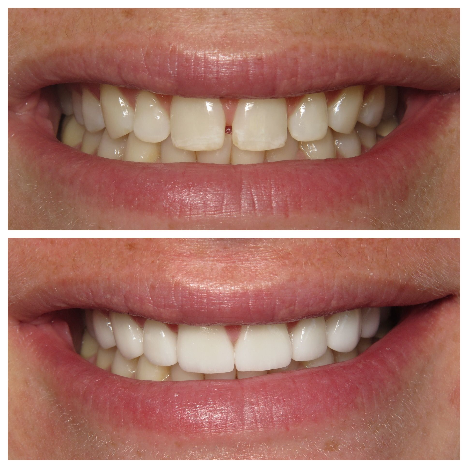 Before and after of gapped teeth