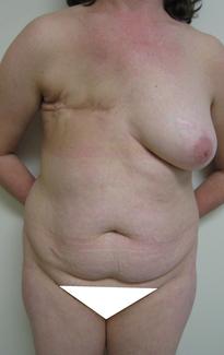 Preop less_cropped_and_painted.jpg