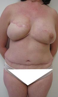 Post bilat DIEP less_cropped_and_painted.jpg