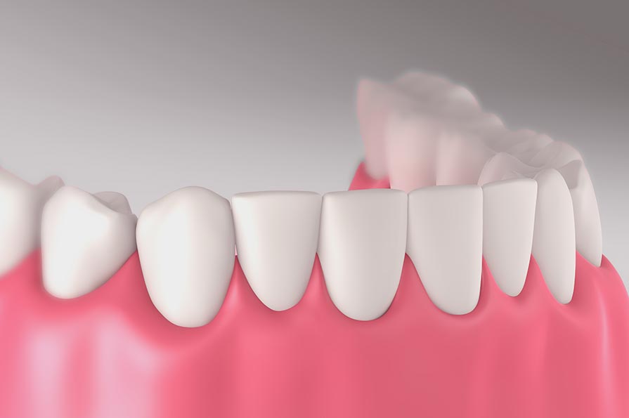 Illustration of healthy gum position