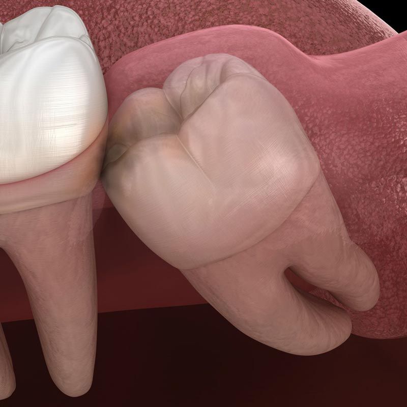 impacted wisdom tooth