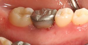 After crown lengthening photo