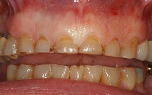 crown lengthening before photo