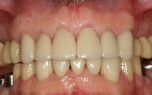 After photo of dental crowns and crown lengthening