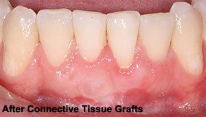 After connective tissue grafts photo