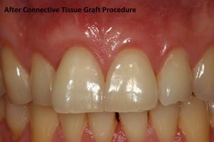 GUm recession after photo