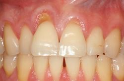 gingival recession