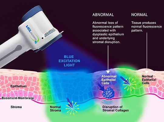 Photo of the VELscope® oral cancer detector