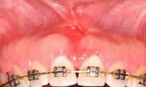 frenectomy after photo