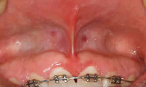 Frenectomy before photo