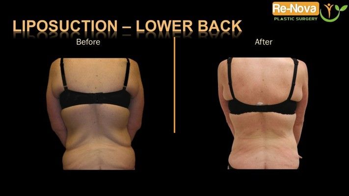 Before and after image of liposuction.