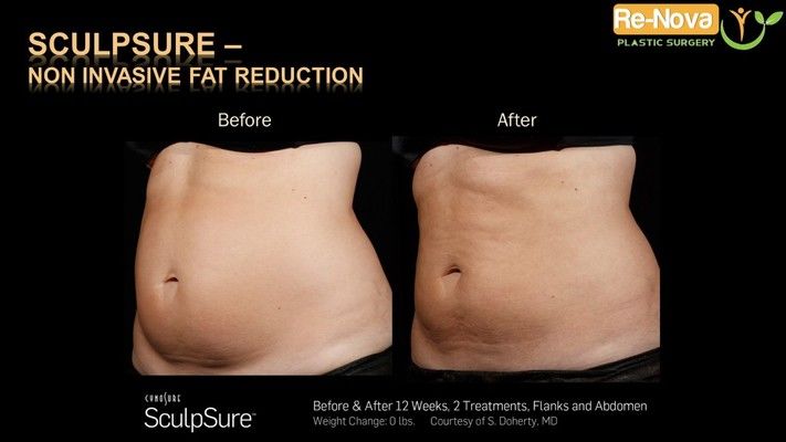 Before and after SculpSure® image