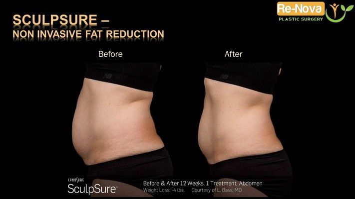 Before and after SculpSure® image