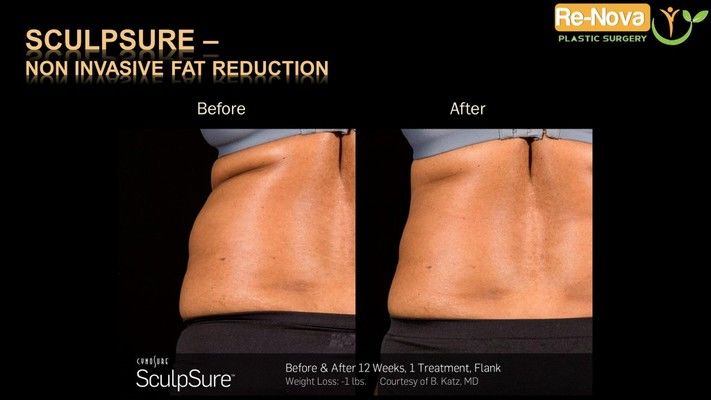 Before and after SculpSure® image