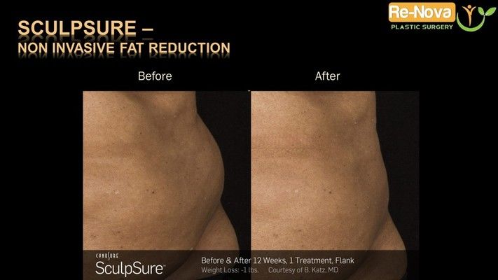 Before and after SculpSure® image