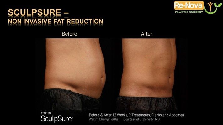 Before and after SculpSure® image