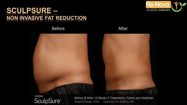 Before and after SculpSure® image