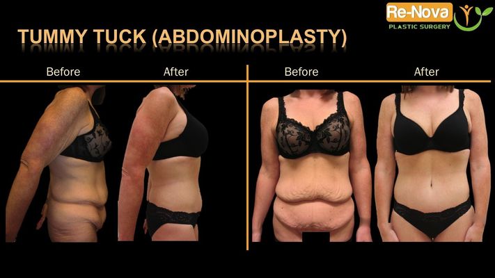 Before and after image of tummy tuck patient.