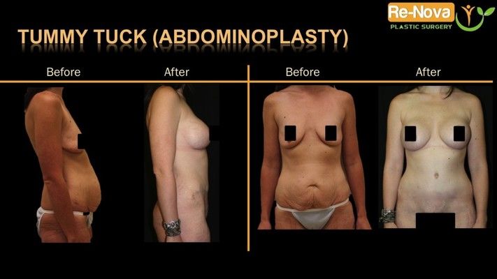 Before and after image of tummy tuck patient.