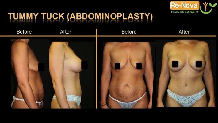 Before and after image of tummy tuck patient.