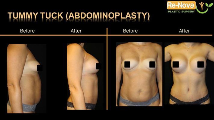 Before and after image of tummy tuck patient.