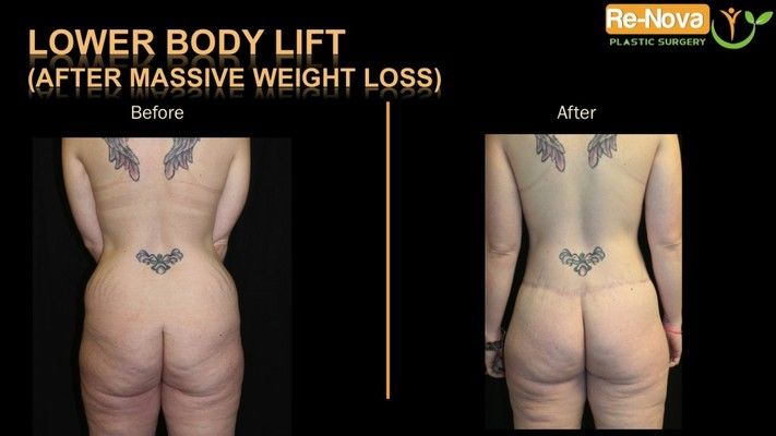 Before and after image of a circumferential body lift patient.
