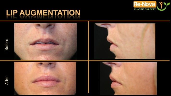 Before and after images of lip augmentation patient.