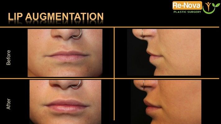 Before and after images of lip augmentation patient.
