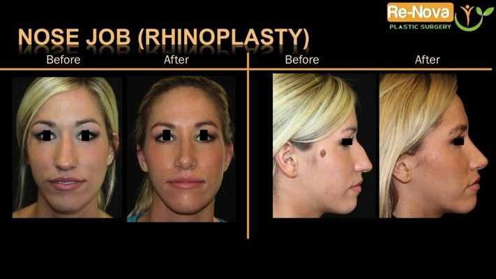 Before and after photos of a rhinoplasty patient.