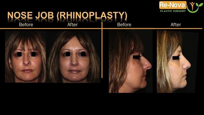 Before and after photos of a rhinoplasty patient.