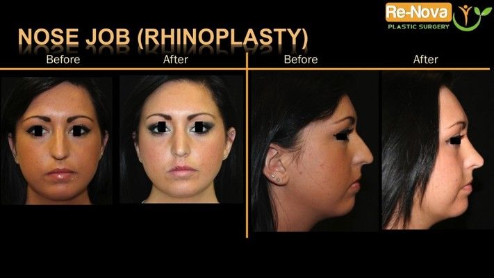 Before and after photos of a rhinoplasty patient.