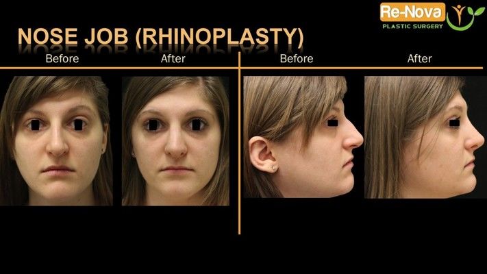 Before and after photos of a rhinoplasty patient.