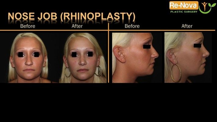 Before and after photos of a rhinoplasty patient.