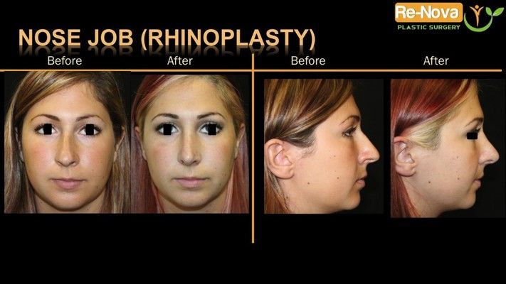 Before and after photos of a rhinoplasty patient.