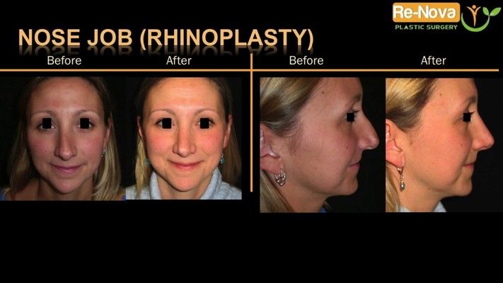 Before and after photos of a revision rhinoplasty patient.