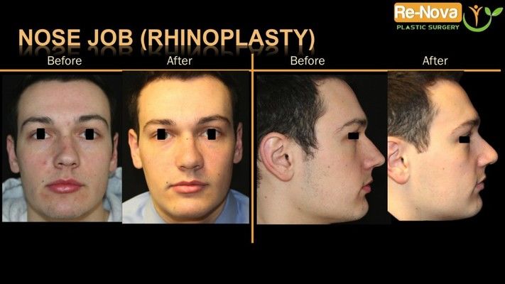 Before and after photos of a revision rhinoplasty patient.
