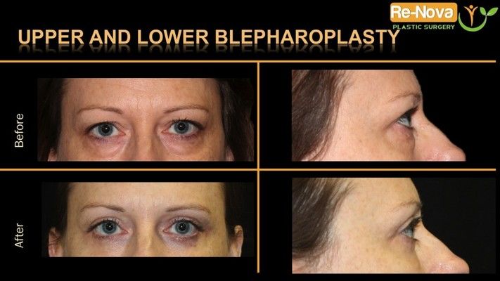 Before and after photos of an eyelid surgery patient.